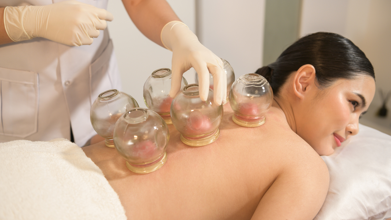 cupping-therapy-1434132669
